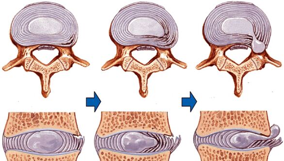 leziuni ale coloanei vertebrale în osteocondroză