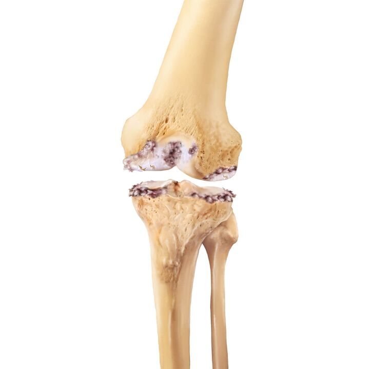 distrugerea articulației genunchiului cu artroză