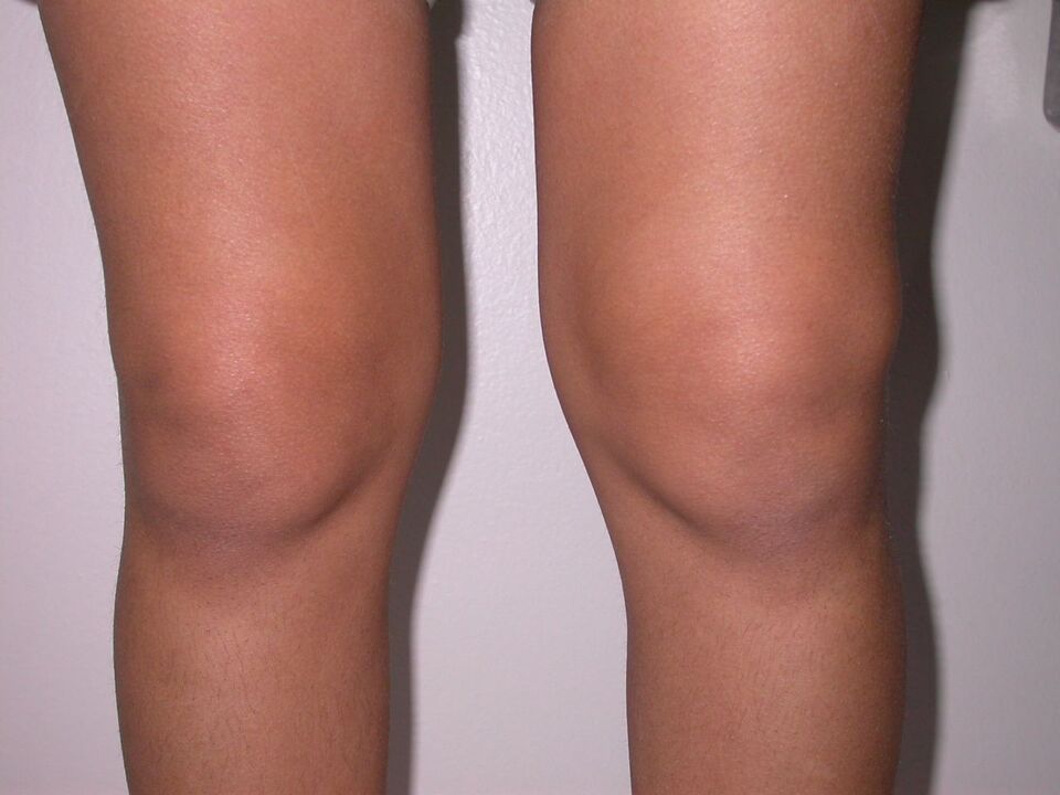 umflarea genunchiului din cauza osteoartritei