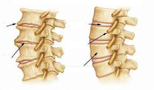 Ce este osteochondroza