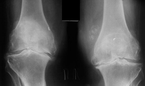 X -RAY ca mod de diagnosticare a artrozei articulației genunchiului