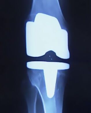 Radiografia unui genunchi cu o proteză artificială după o intervenție chirurgicală de înlocuire a articulației