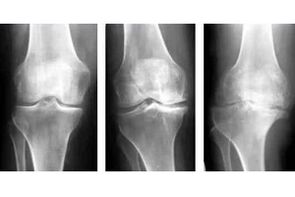 etapele de artroză a articulației pe o radiografie