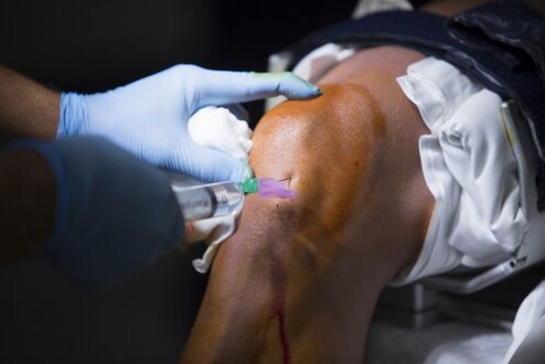 Injecții în articulația genunchiului pentru artroză