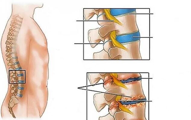 osteocondroza coloanei lombare provoacă dureri de spate